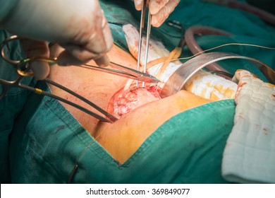 Kidney Surgery For Remove Stone