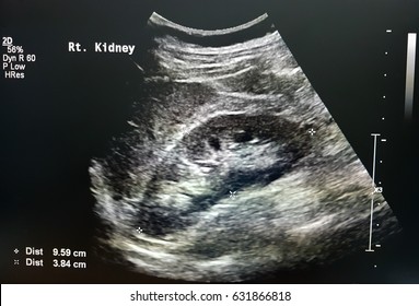 723 Ultrasound scan kidney Images, Stock Photos & Vectors | Shutterstock