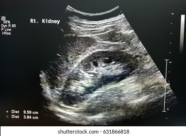 Kidney Ultrasound