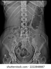 Kidney,Ureter,Bladder Radiograph showing Double J Stent  - Shutterstock ID 2222848887