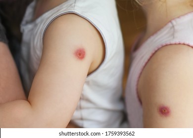 Kids With A Reaction To The BCG Vaccine On The Forearm