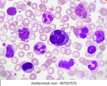 Kind Of White Blood Cell In Peripheral Blood Smear