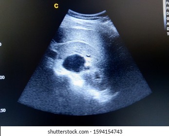 Kindey Cyst By Ultrasound Scan