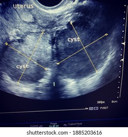 Kissing Ovarian Cyst Is One Form Of An Ultrasound Image Of Endometriosis Cysts (endometrioma)