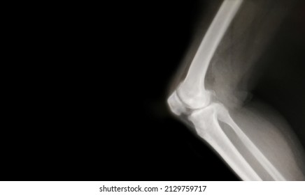 Knee Bone Computer X-ray Images