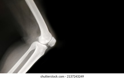 Knee Bone Computer X-ray Images