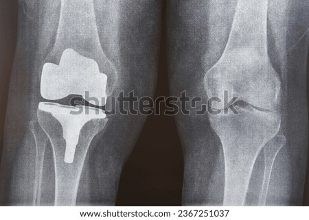 Knee cap replacement xrays. Titanium implant. Osteoarthritis. Articular cartilage