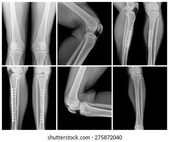 knee collection: x-ray of knee joint