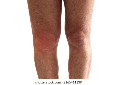 Knee Effusion, Fluid Or Water Round The Knee Joint. Adult Man With Knee Swollen The Swelling And Redness Of The Skin Because Of Fluid Build Up Inside. 