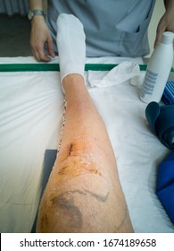 Knee Injury After Stitches Have Been Removed  After Knee Surgery.