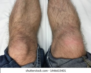 Knee Injury To The Right Leg Swollen Knee Cap Due To Sharp Blow And Diagnosed Soft Tissue Damage.