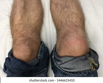 Knee Injury To The Right Leg Swollen Knee Cap Due To Sharp Blow And Diagnosed Soft Tissue Damage.