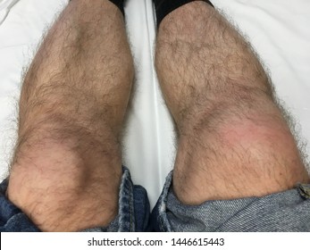 Knee Injury To The Right Leg Swollen Knee Cap Due To Sharp Blow And Diagnosed Soft Tissue Damage.