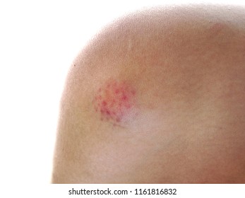 Knee injury, stale and swelling caused by falling at the floor on white background.