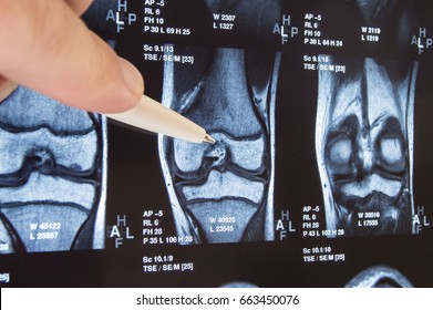 Knee joint x-ray or MRI. Doctor pointed on area of knee joint, where pathology or problem is detected, such fracture, destruction of joint, osteoarthritis. Diagnosis of knee diseases by radiology