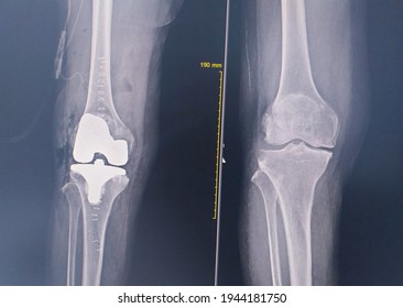 Knee Joint X-ray Post Op Rt.Knee Prostesis Replacement.Total Knee Arthroplasty(TKA).Medical Image Concept.