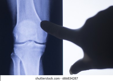 Knee Joint Xray Test Scan Results Of  Patient With Arthritis And Joints Pain In Knees On Screen With Surgeon.