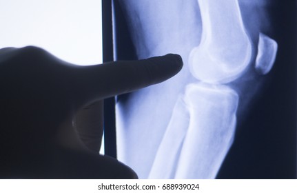 Knee joint xray test scan results of  patient with arthritis and joints pain in knees on screen with surgeon.