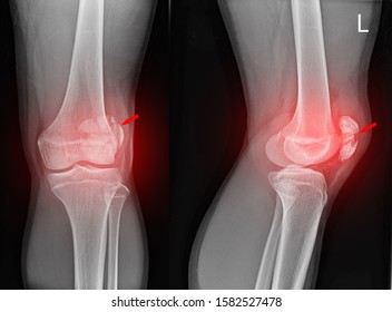 Knee Joint X-ray(AP And LATERAL) View Fracture And Displacement Of The Patella Bone Or Kneecap On Red Arrow Point.