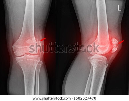 Knee joint x-ray(AP and LATERAL) view fracture and displacement of the patella bone or kneecap on red arrow point. ストックフォト © 