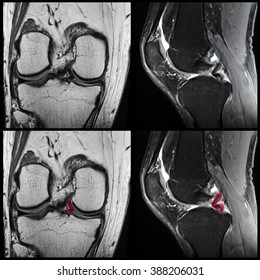 Knee, Meniscal Tear, MRI