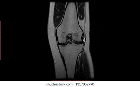 950 Mri knee Images, Stock Photos & Vectors | Shutterstock