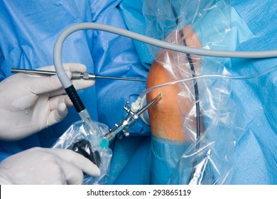 Knee operation - arthroscope