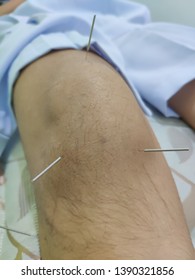 Knee Pain, Knee Injury, Acupuncture