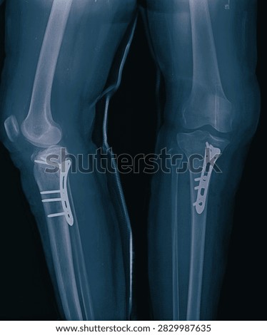 Knee and proximal tibia radiography showing surgical plate and screw fracture fixation