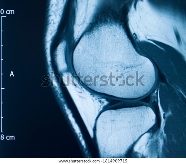 Knee Sports Injury Mri Mcl Grade Stock Photo 1614909715 | Shutterstock