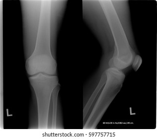knee tomography