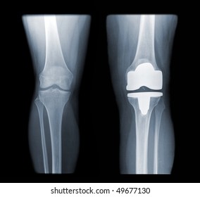 knee and knee with total replacement x-ray image ob black background