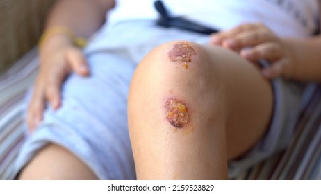 Knee Wounds With Inflammation And Redness Of The Skin In Boy Child - Treat And Disinfect The Wound With Disinfectant And Gauze Prior To Scab Formation, Injury And Pain In Childhood - Father Treats Son