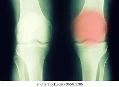 Knee Xray Photo