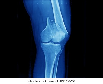 Knee x-ray showing closed fracture of distal femur with intraarticular involvement and displacement. The patient needs surgical treatment with open reduction and internal fixation with plate.