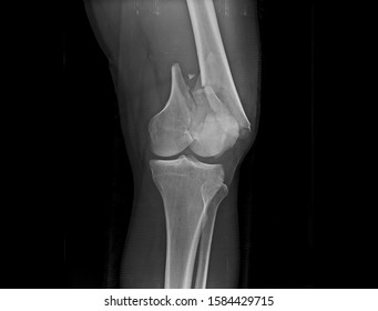 a patient underwent closed reduction of a closed fracture