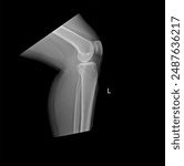 Knee x-rays for diagnostic purposes. meniscus tear. Bilateral Knee Joint radiographic image of both knees in anteroposterior view for detection of Osteoarthritis Knee. humerus Injuries.