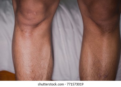 tissue damage soft scratching scar knees accident both shutterstock vectors legs