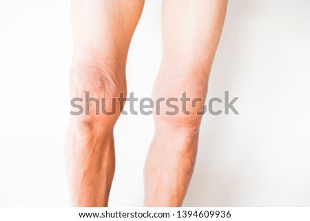 Knees that have problems with the deterioration of the bones of the elderly On a white background
