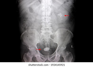 A KUB Xray Film Of A Patient With A Large Urinary Bladder Stone And Multiple Left Kidney Stones.