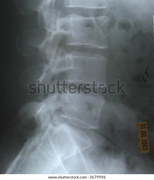 lumbar l5 s1