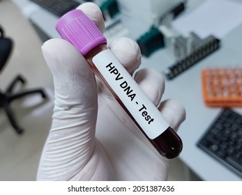 Lab Technologist Hold Blood Sample For HPV DNA - Test. Laboratory Medical Testing Concept 