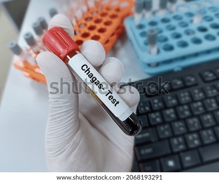 Lab Technologist hold blood sample for Chagas  test. Laboratory medical testing concept. 