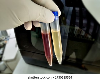 Lab Technologist hold urine sample tube for analysis. Medical urine test reddish urine sample, Normal stow color urine sample, plenty RBC abd Pus cell. close-up
