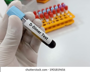 Lab Technologist holds Blood samples for D Dimer test. Corona patient monitoring test in ICU. Close view. Deep venous thrombosis. Iintra vascular coagulation. Aortic dissection.