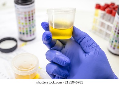 laboratorian hand with glove, performing EAS type urine test, Abnormal Sediment Elements.