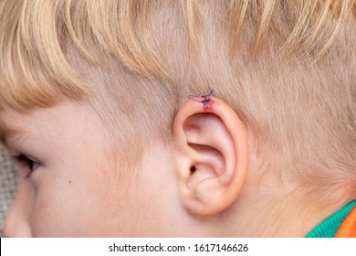 Laceration In Child. Wound On Ear Of Young Toddler. Bleeding Auricle Rupture. Medical, Personal Injury And Pain Concept.