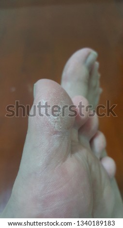 Lack of care the foots dry skin of women
on blur background. 