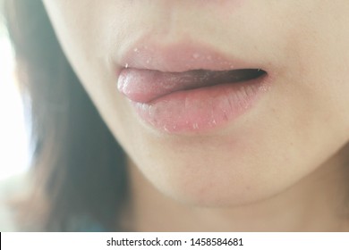 Lack Of Saliva Causes Dry Lips, Dry Mouth