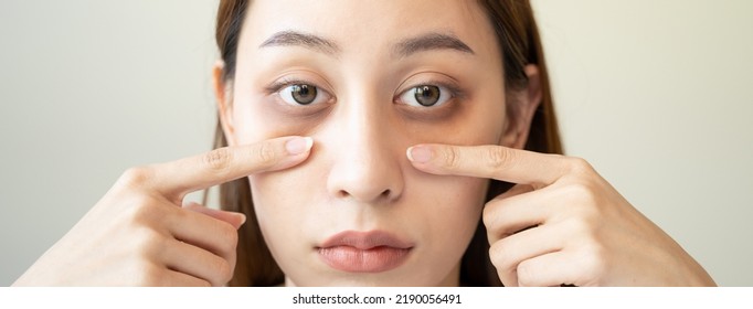 lack of sleep problem,  Worried Asian young woman pointing finger at dark circles under her eyes